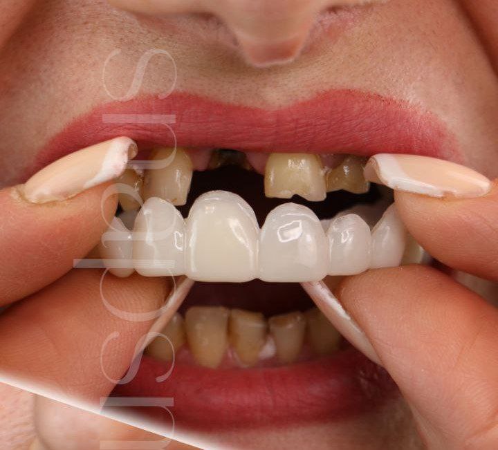 لمینت دندان دو فک اصلی برای خرابی 6 دندان vision6 دکترفروش  لمینت دندان دو فک اصلی برای خرابی 6 دندان vision6 دکترفروش