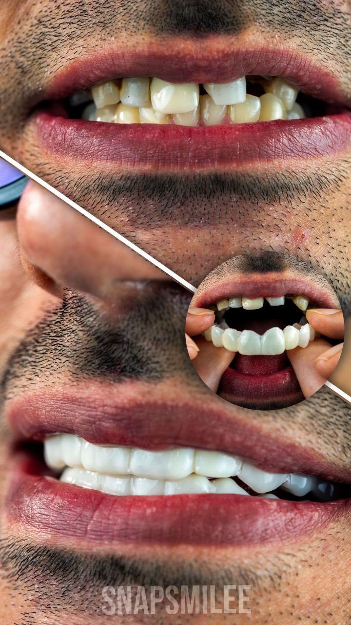 لمینت دندان دو فک اصلی برای خرابی 8 دندان vision8 دکترفروش  لمینت دندان دو فک اصلی برای خرابی 8 دندان vision8 دکترفروش