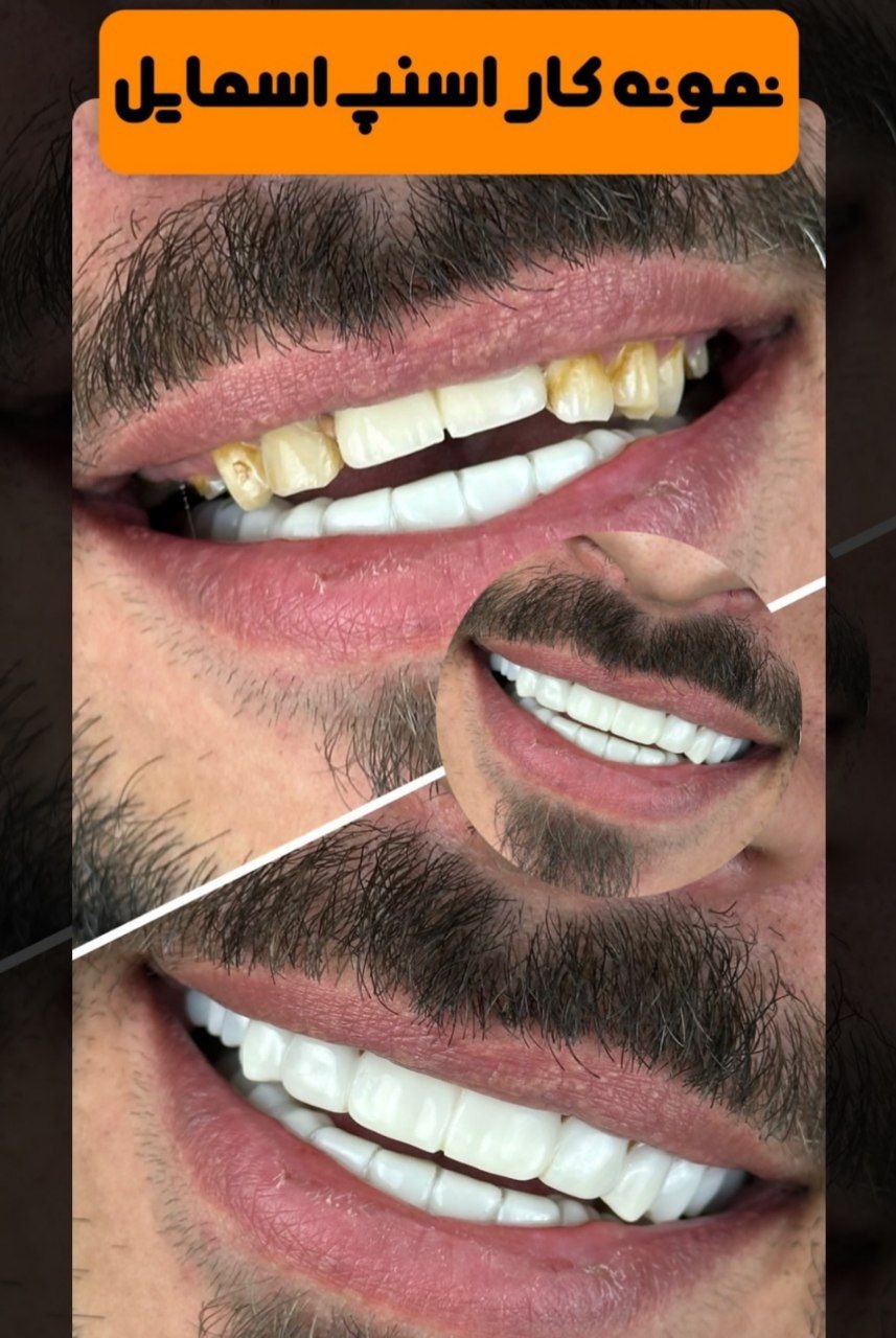 لمینت دندان دو فک اصلی برای خرابی 10 دندان vision10 دکترفروش  لمینت دندان دو فک اصلی برای خرابی 10 دندان vision10 دکترفروش